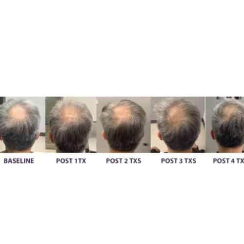 Hair Restoration